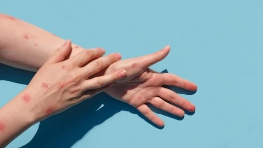 Kiat Cegah Penyebaran Cacar Monyet di Indonesia menurut Peneliti