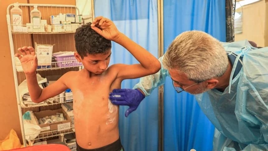 Wabah Kudis Serang Pengungsi Gaza, Imbas Minimnya Akses Air Bersih dan Sanitasi