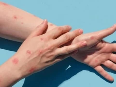 Kiat Cegah Penyebaran Cacar Monyet di Indonesia menurut Peneliti