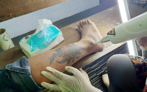 LAZISNU Rembang Buka Klinik Penghapusan Tato Gratis